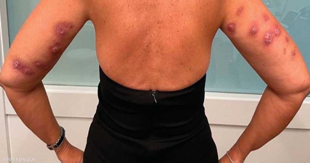 تحذير من آثار خطيرة لحقن إذابة الدهون غير المصرّح بها