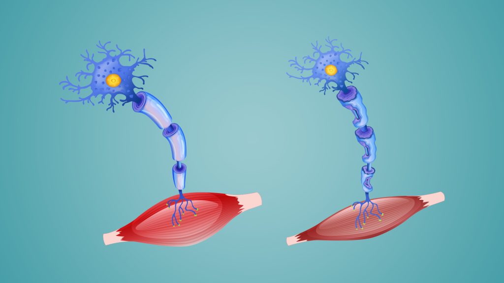 علاج جديد واعد لمرض شاركو القاتل