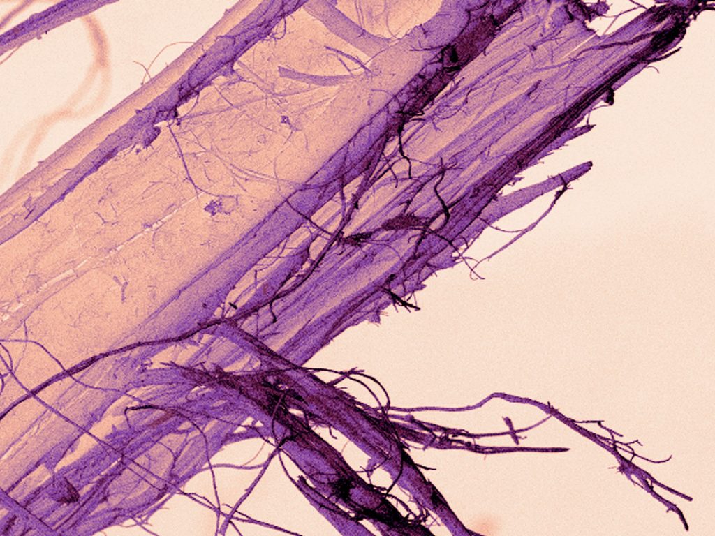 الأسبستوس.. مرضه يؤدي إلى انتفاخ الأظافر