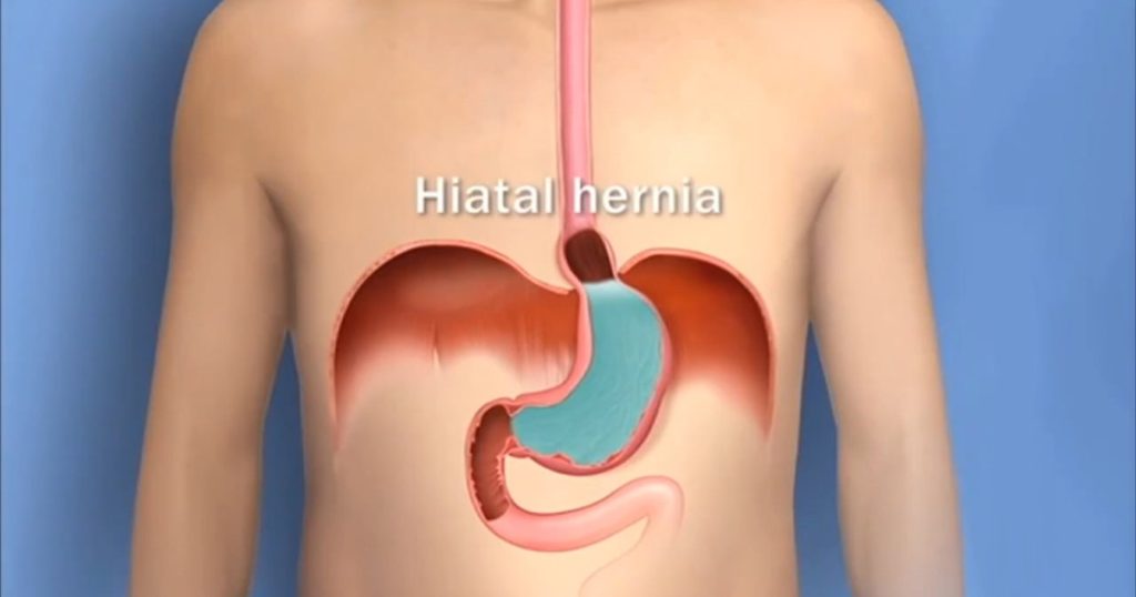 تطوير منصة للذكاء الاصطناعي لتحسين تشخيص سرطان المريء