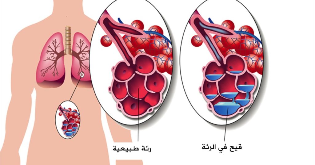 التهاب الشعب الهوائية الحاد.. أعراضه ومخاطره