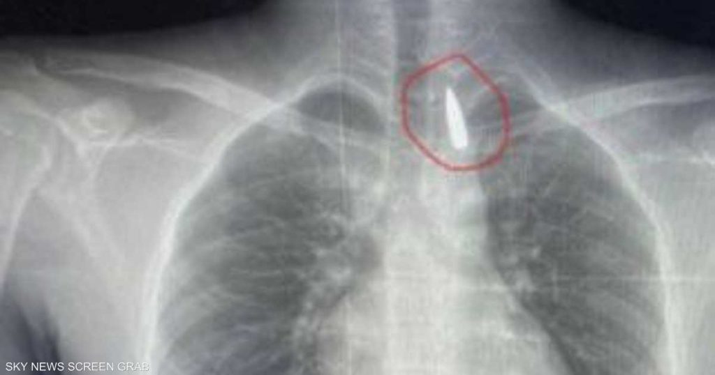 مقذوف استقر في صدره.. إنقاذ حياة مصاب من غزة في مصر