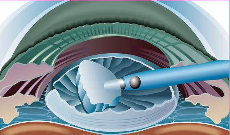 كم تكلفة عملية المياه البيضاء