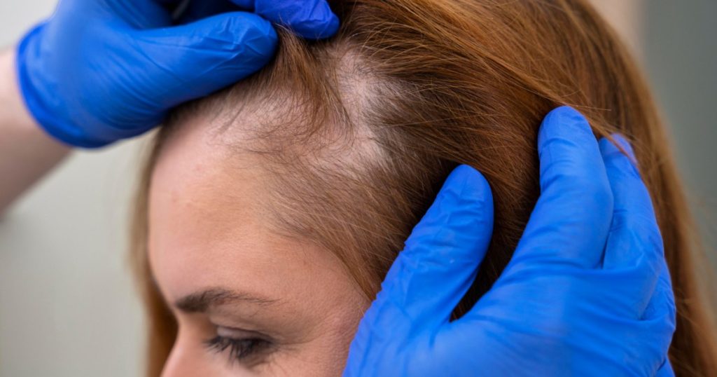 من الهرمونات إلى التوتر.. ما الذي يسرق شعر النساء؟