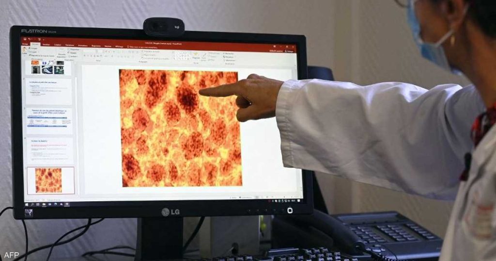 لقاح لسرطان البنكرياس يظهر نتائج مبشرة في تجربة أولية